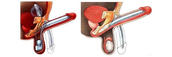 Faloprotética com prótese inflável (esquerda) e plástica (direita)