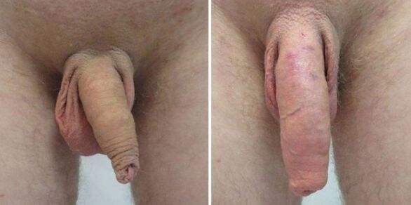 Pênis antes e depois de pendurar pesos